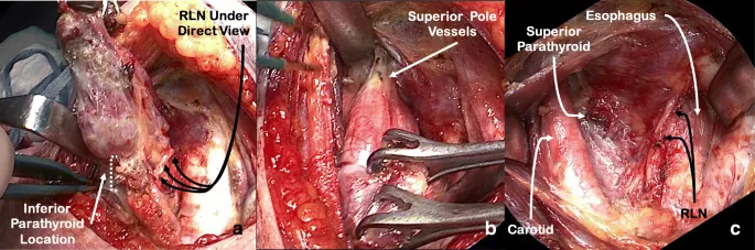 Thyroidectomy: RLN and parathyroid gland identification
