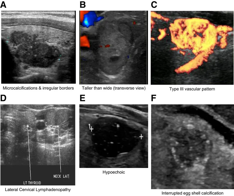 Thyroid Nodule Ultrasound: High-Risk Features
