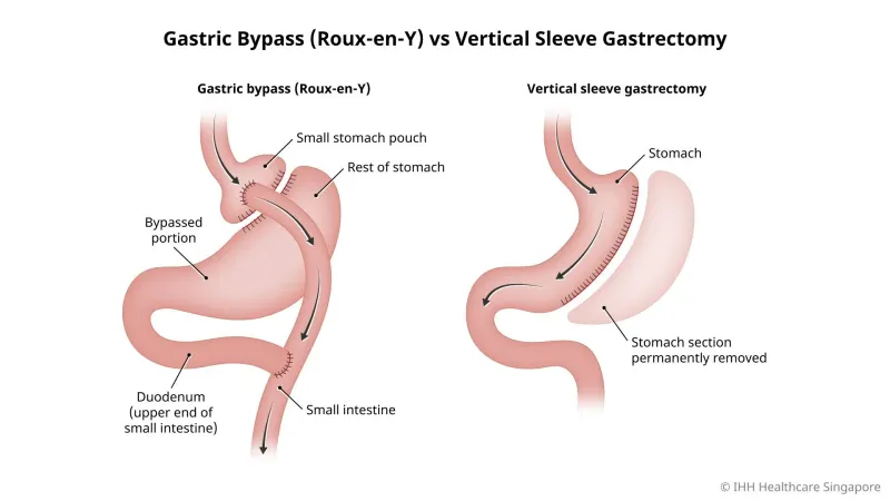 Gastric Bypass vs. Vertical Sleeve Gastrectomy