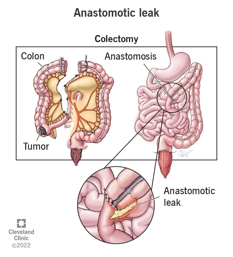 Anastomotic Leak After Colectomy