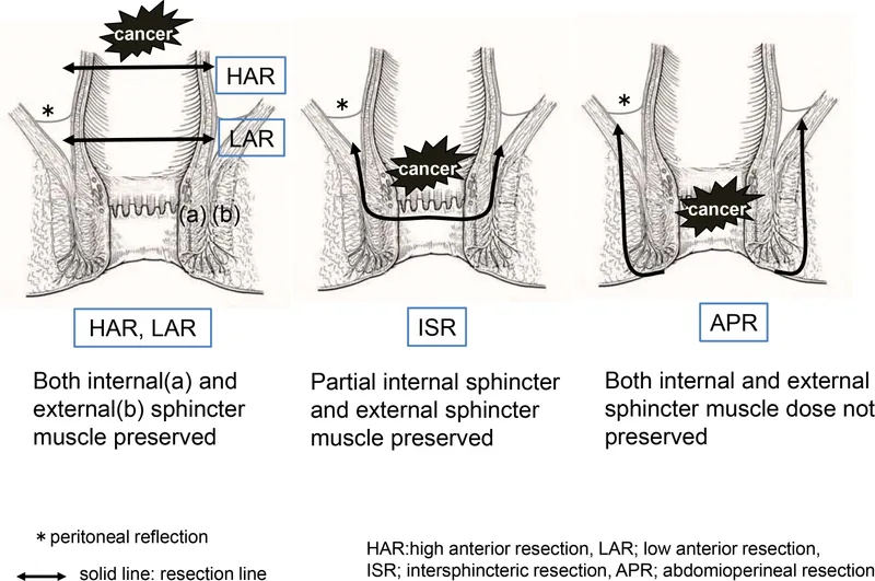 Rectal cancer surgical options: HAR, LAR, ISR, APR