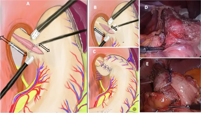 Heller Myotomy and Dor Fundoplication Surgical Steps