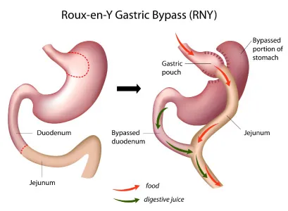 Roux-en-Y Gastric Bypass: Anatomy Diagram