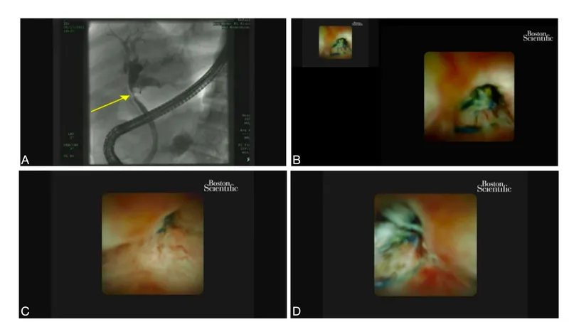 Biliary Spyglass cholangioscopy of cholangiocarcinoma
