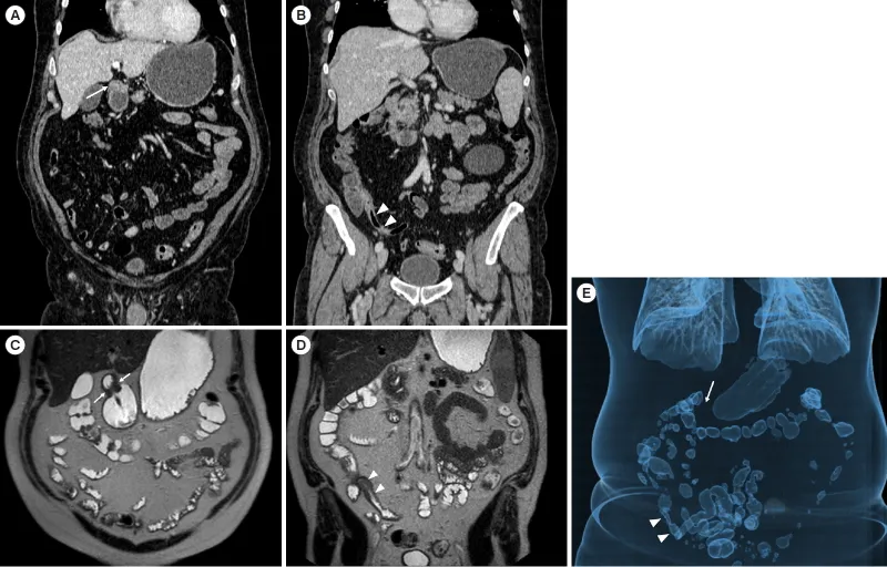 CT/MR/3D reconstruction of Crohn's disease stricture