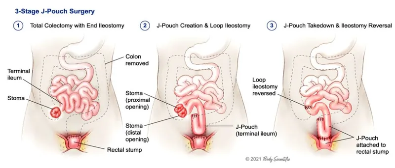 3-Stage J-Pouch Surgery for Ulcerative Colitis
