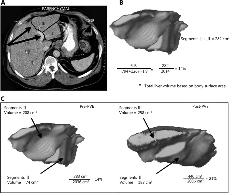 CT volumetry of liver remnant before and after PVE