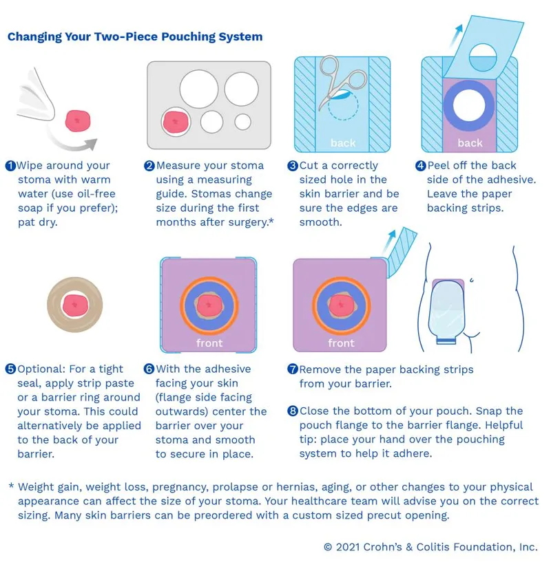 Changing a Two-Piece Ostomy Pouching System