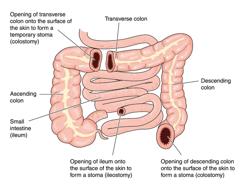 Ileostomy and Colostomy Anatomical Locations