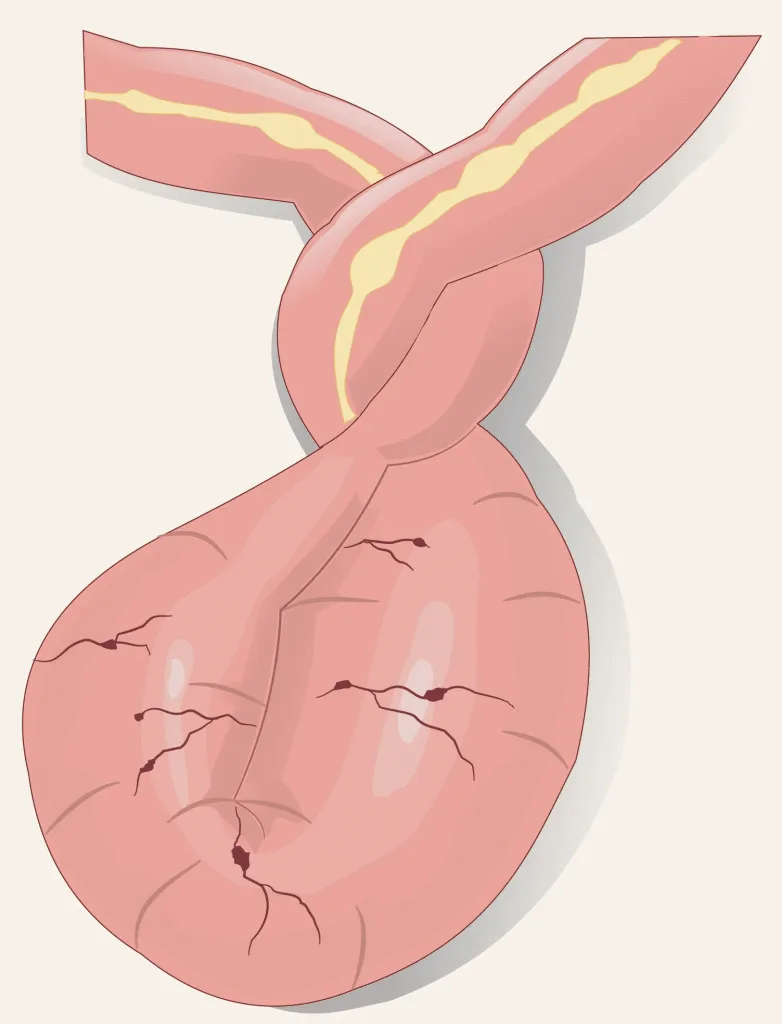 Small bowel volvulus with ischemia