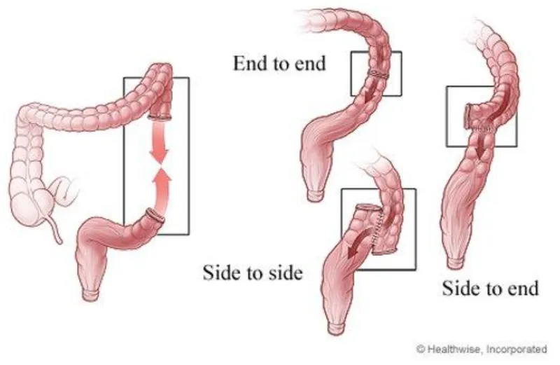 Types of Intestinal Anastomosis