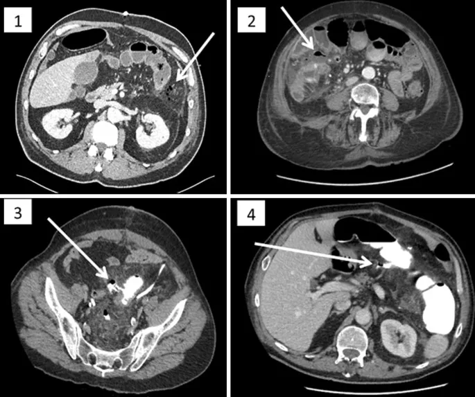 CT: Small bowel anastomotic leak with extraluminal contrast