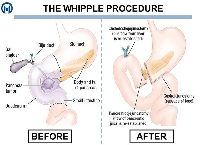 Whipple procedure: Before and after organ resection