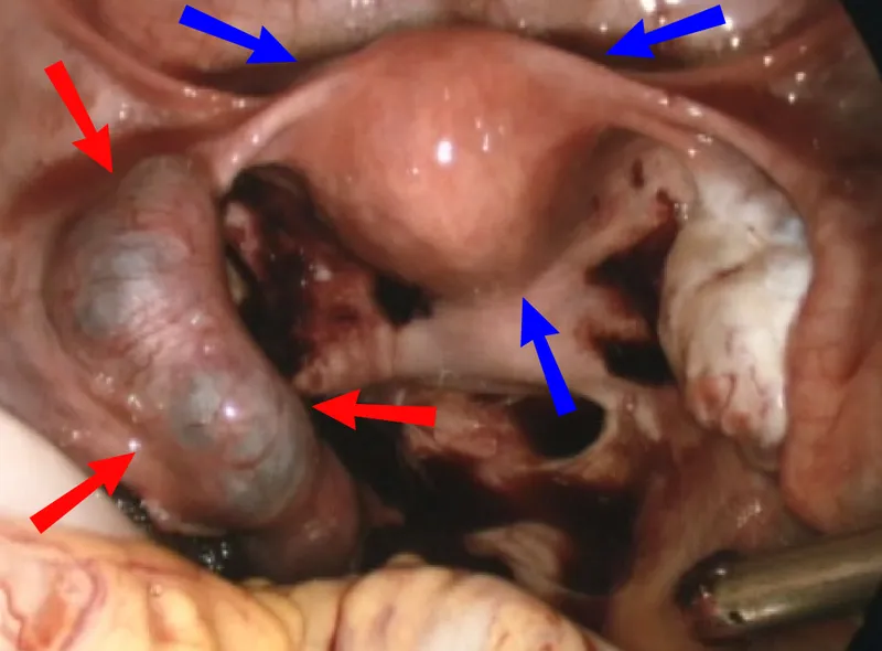 Laparoscopic view of ruptured tubal ectopic pregnancy