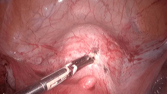 Laparoscopic view of chocolate cyst endometrioma