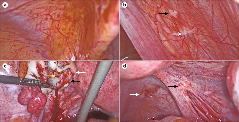 Laparoscopic views of peritoneal endometriosis lesions