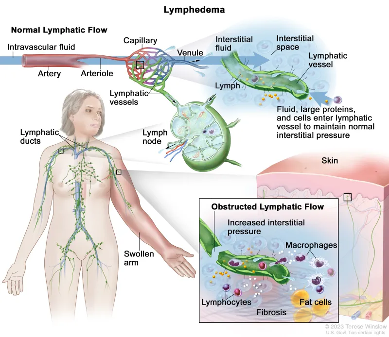 Lymphedema: Normal vs. Obstructed Lymphatic Flow