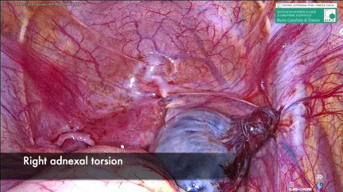 Laparoscopic view of right adnexal torsion