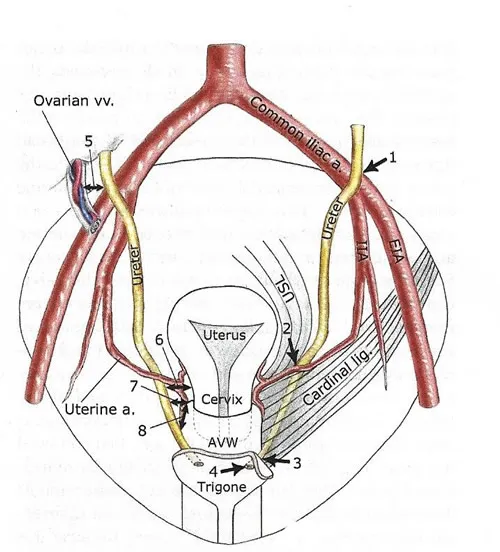 Ureter and uterine artery relationship during hysterectomy