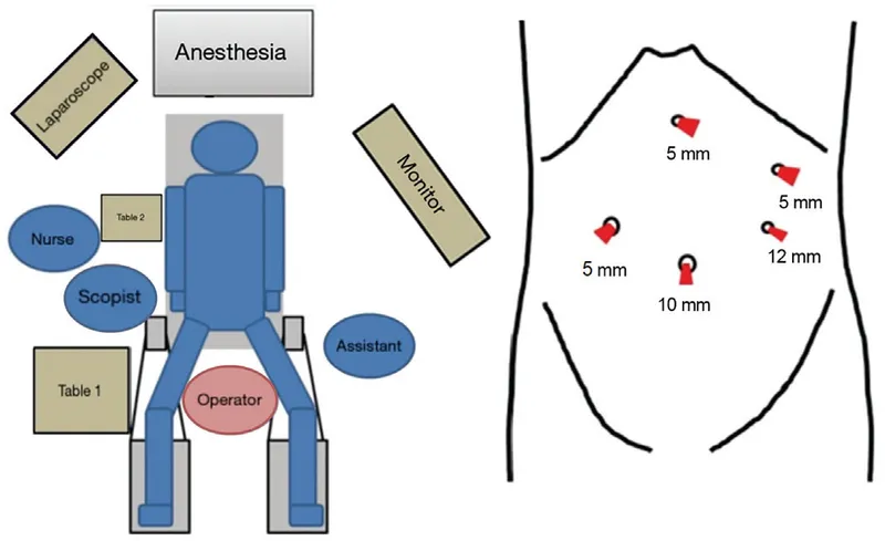 Laparoscopic Surgery Setup and Trocar Placement