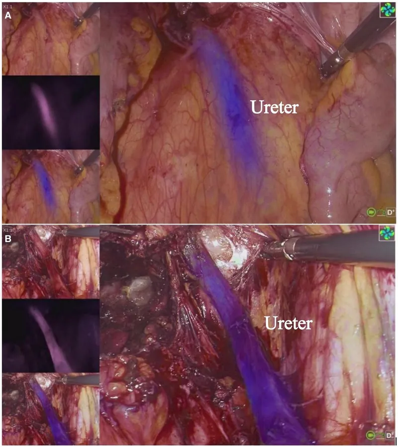 Laparoscopic view of ureter with indocyanine green