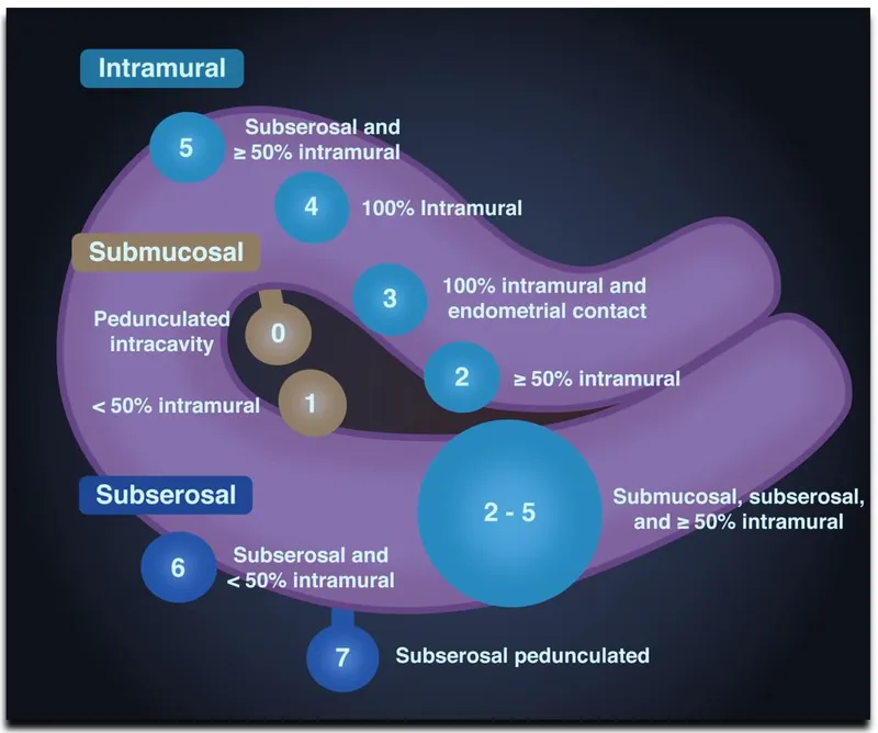 FIGO Classification of Uterine Fibroids