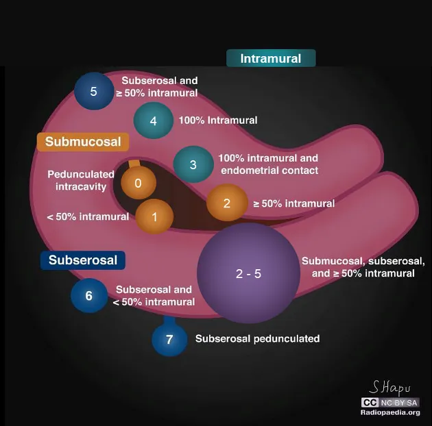 FIGO classification of leiomyomas