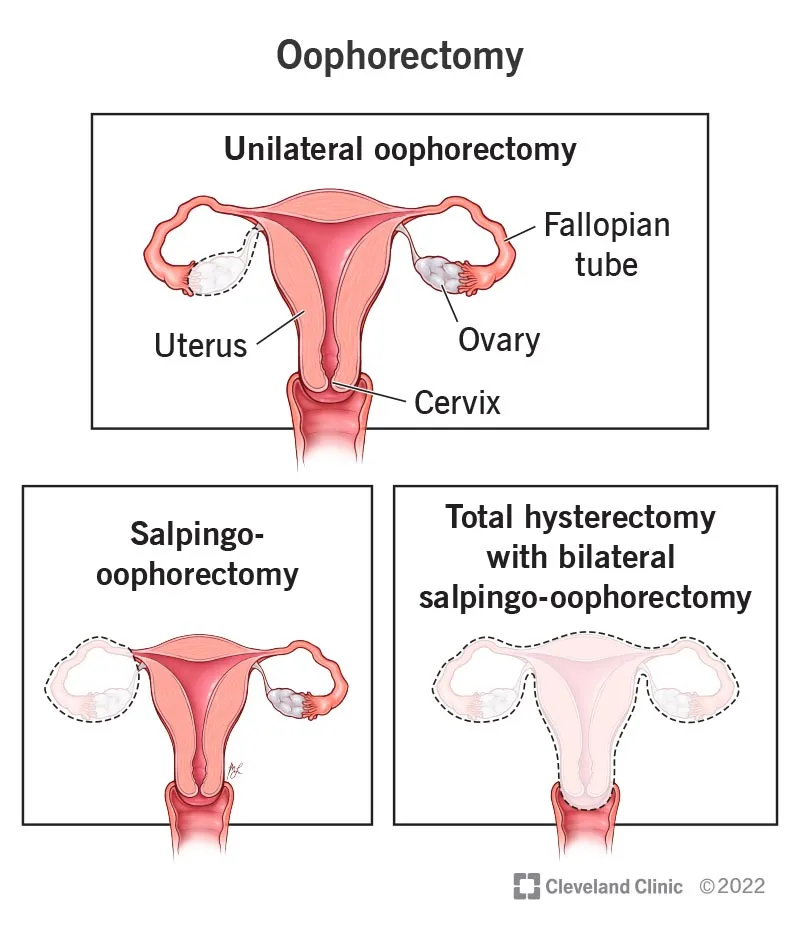 Types of Oophorectomy Procedures