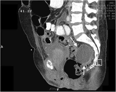 CT: Post-hysterectomy pelvic abscess with gas and fluid