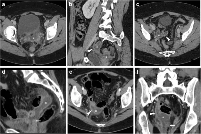 CT scan of postoperative pelvic abscess