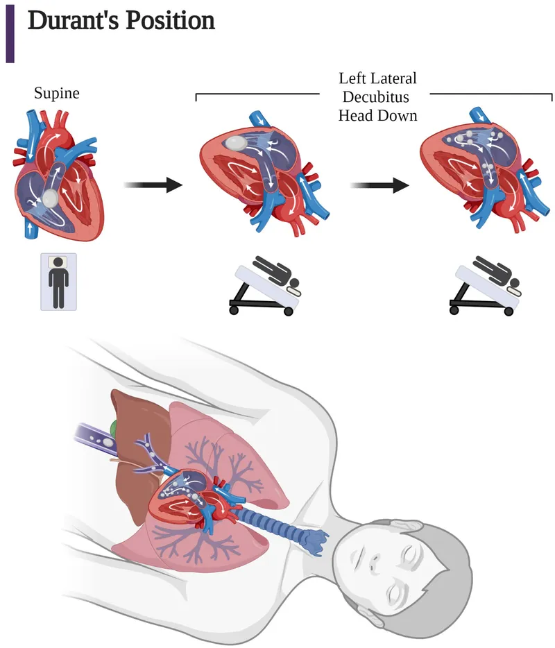 Durant's Maneuver for Air Embolism