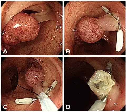 Endoscopic Polypectomy Steps