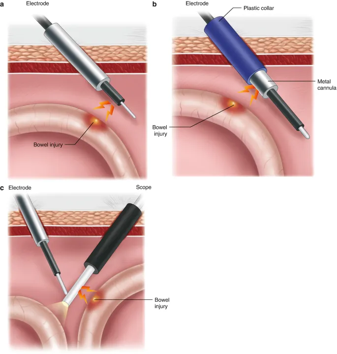 Laparoscopic electrosurgical injury mechanisms