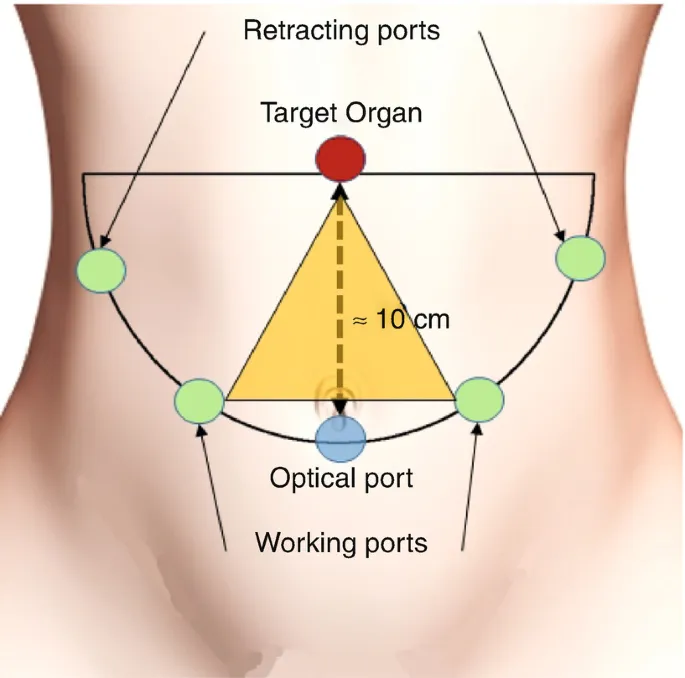 Laparoscopic trocar placement and triangulation diagram