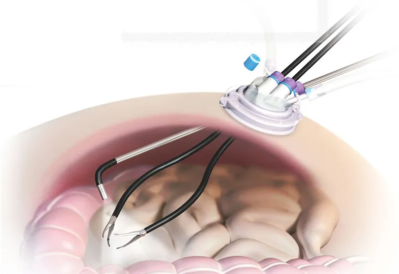 Single-incision laparoscopic surgery port and instruments