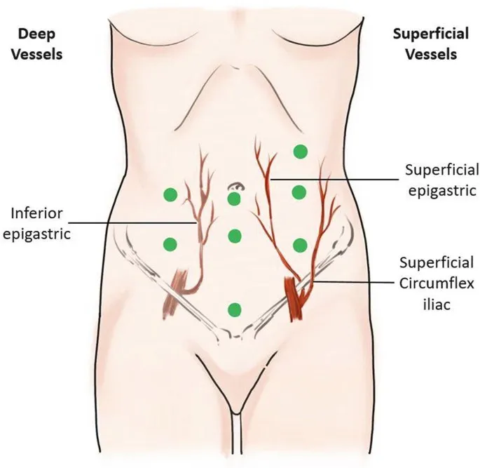 Laparoscopic port sites and abdominal wall vessels