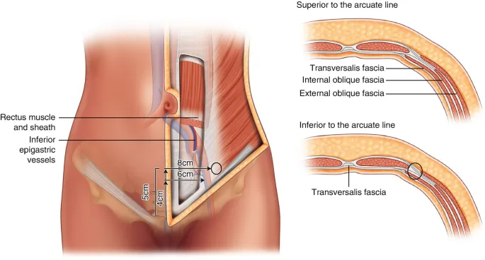 Laparoscopic port sites and inferior epigastric artery