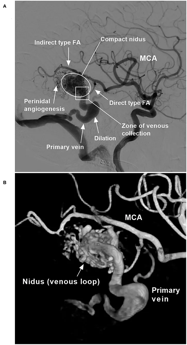 Cerebral AVM angiogram with nidus and draining vein