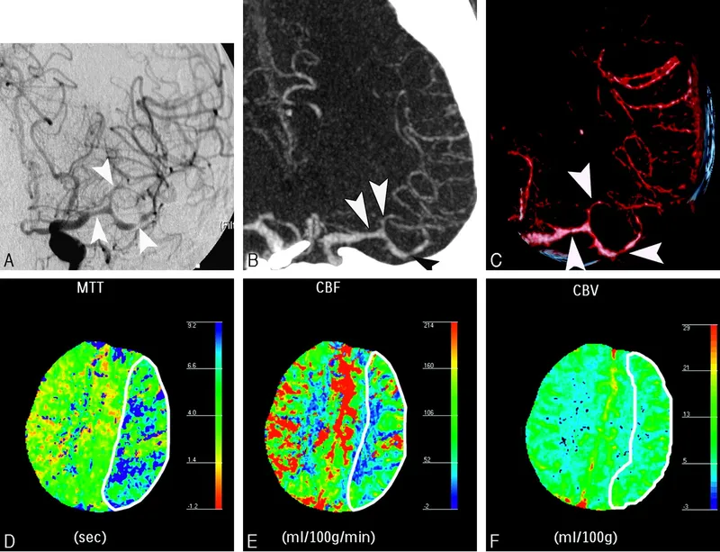 CTA brain showing cerebral vasospasm after SAH