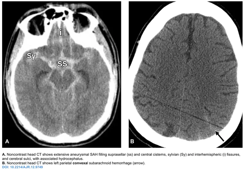 CT head showing subarachnoid hemorrhage