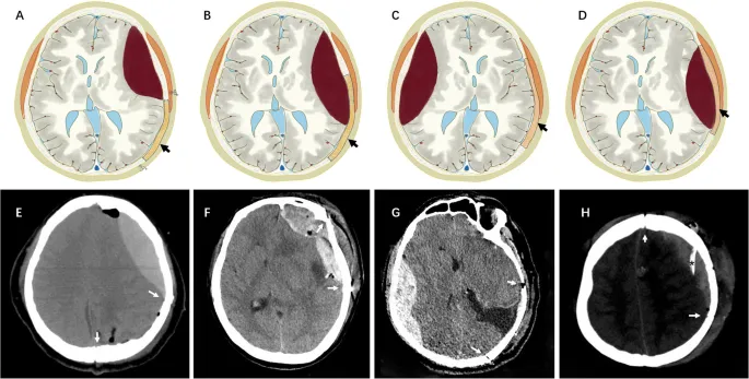Post-craniotomy epidural hematoma: diagrams and CT scans