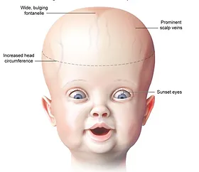 Infant with hydrocephalus: clinical signs