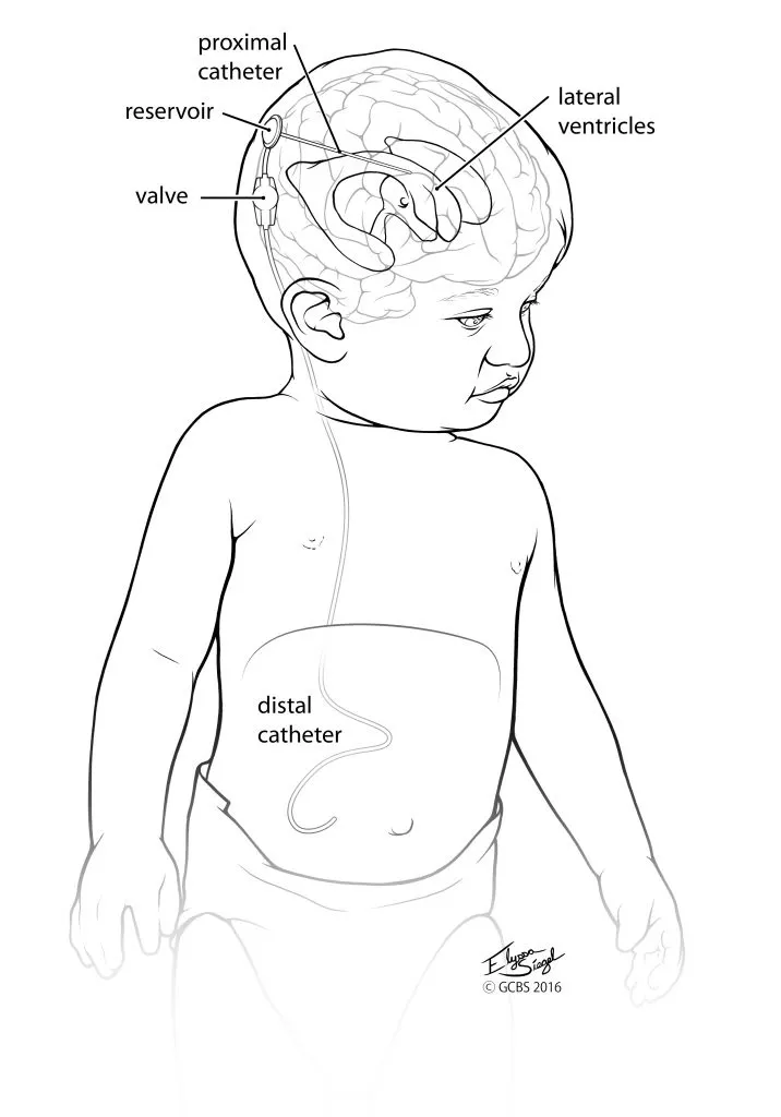 Ventriculoperitoneal (VP) Shunt Placement in a Child