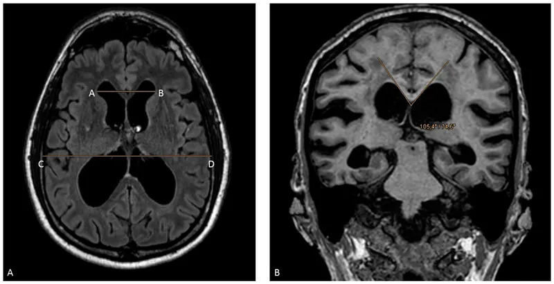 Axial and Coronal MRI: Ventriculomegaly in NPH