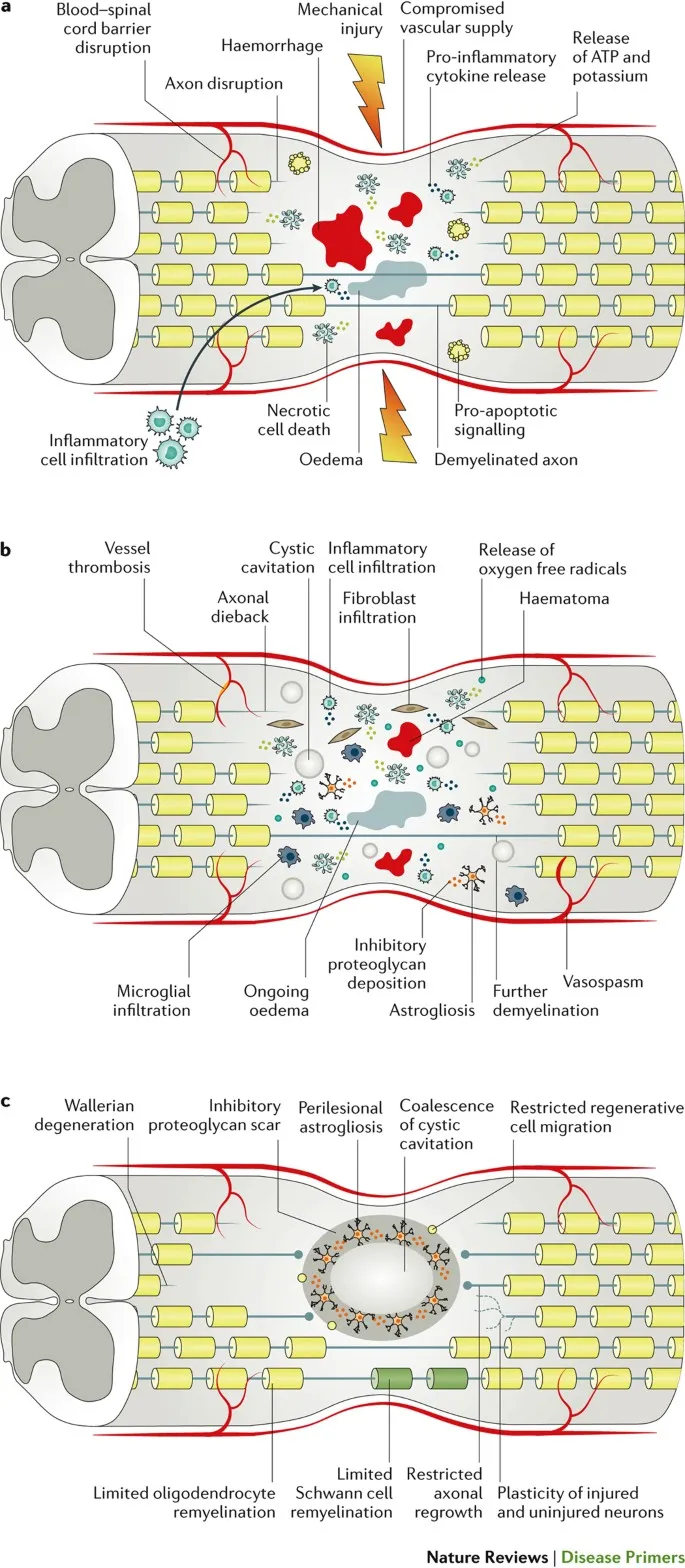 Spinal Cord Injury: Primary and Secondary Injury Mechanisms