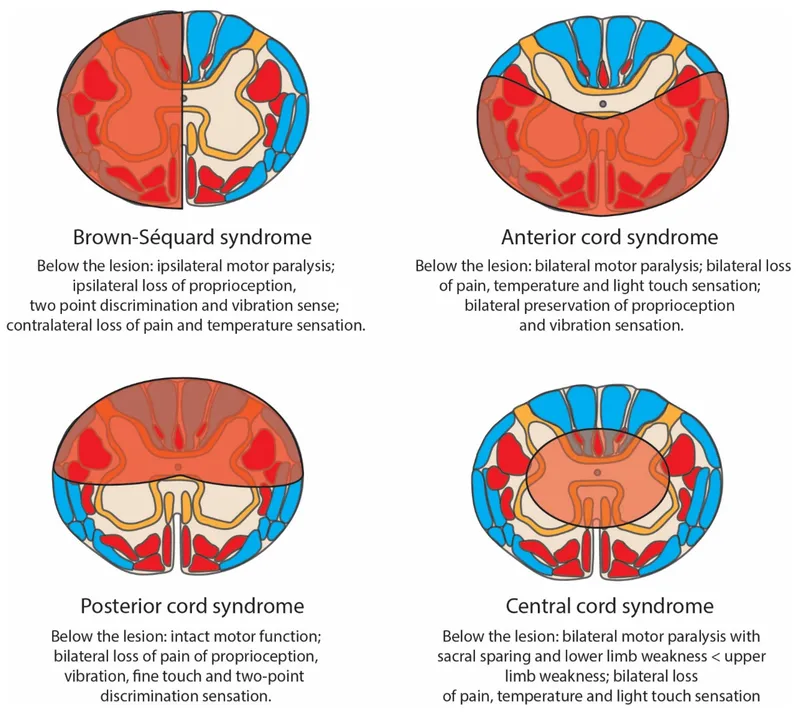 Incomplete Spinal Cord Syndromes Diagram
