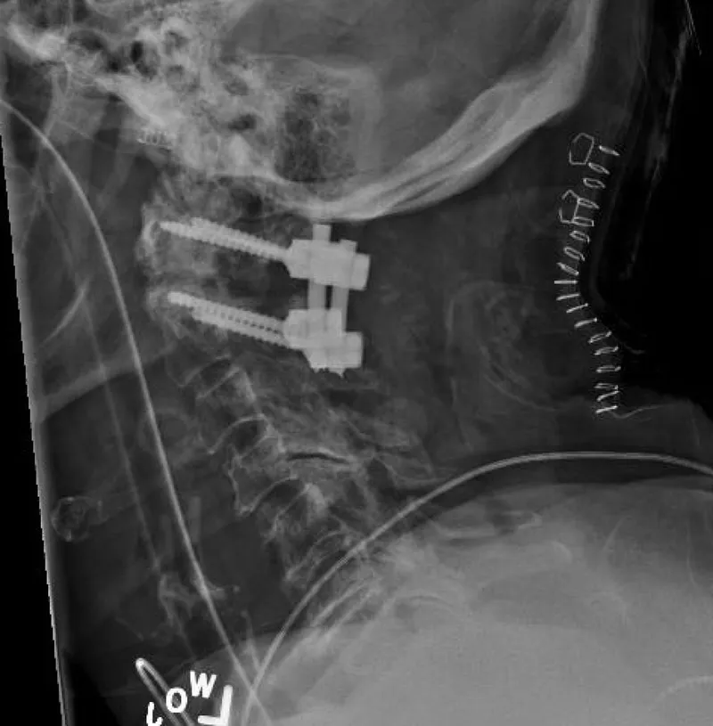 Cervical spinal fusion X-ray with pedicle screws and rods