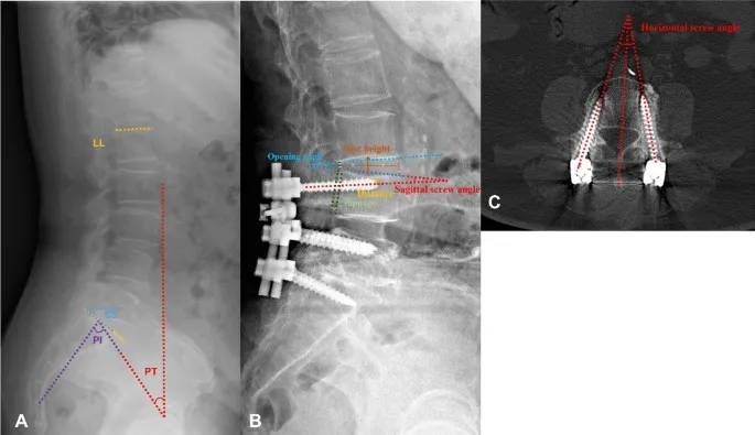 Spinal fusion imaging with measurements