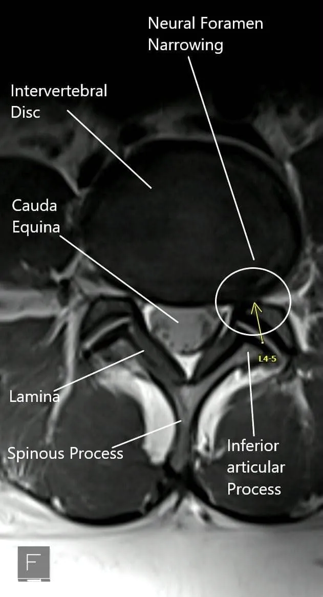 MRI Lumbar Spine: L4-L5 Disc Herniation & Nerve Compression