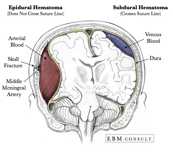 Epidural vs. Subdural Hematoma: Anatomy and Characteristics